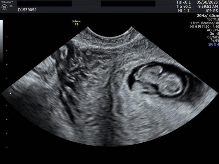 What to Do After a Miscarriage Let's Make a Plan!